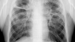 Fibrosis Paru: Mengenal Kondisi Pernapasan yang Perlu Diwaspadai
